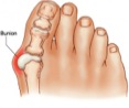 bunion-300x250