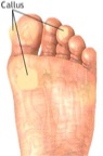callus