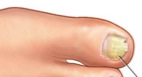 thicknails